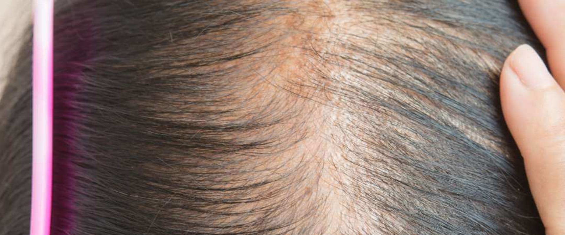 Understanding Iron-Deficiency Anemia and its Link to Hair Loss