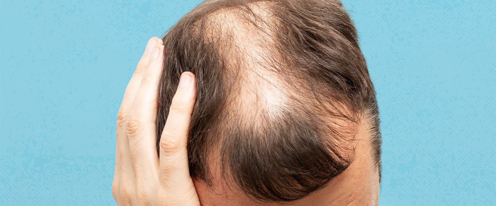 Lifestyle Factors and Male Pattern Baldness: Understanding and Managing Mental and Physical Challenges