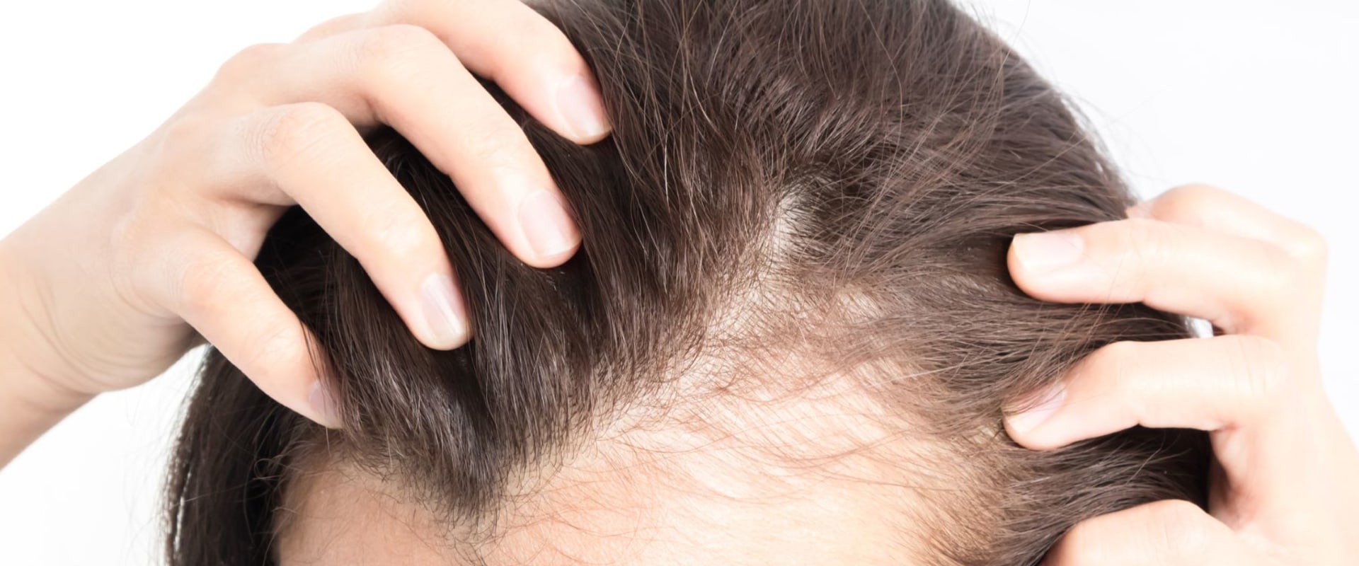 Understanding and Overcoming Female Hair Loss