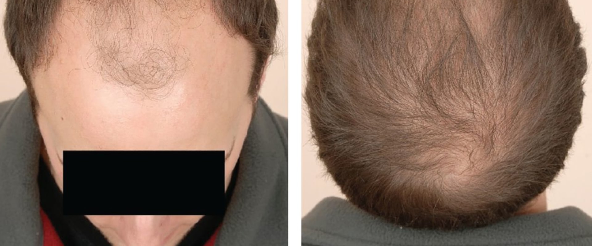 Understanding Male Pattern Baldness: Causes and Management