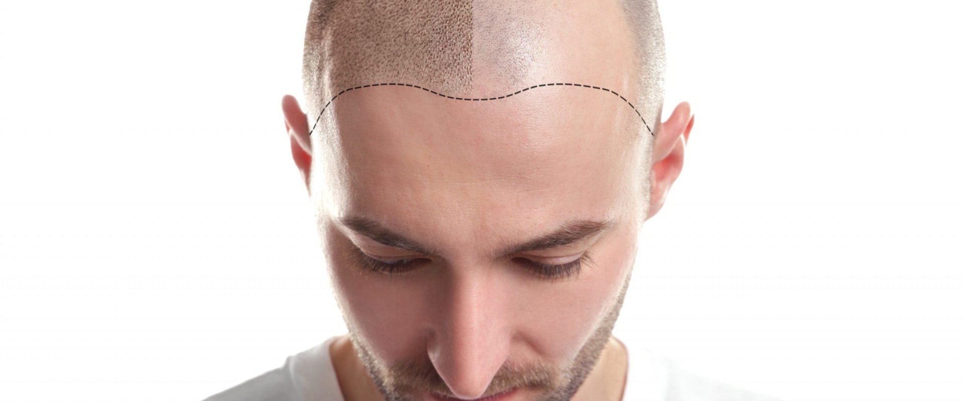 Scalp Camouflage Techniques: Improving Mental and Physical Health through Hair Loss Solutions