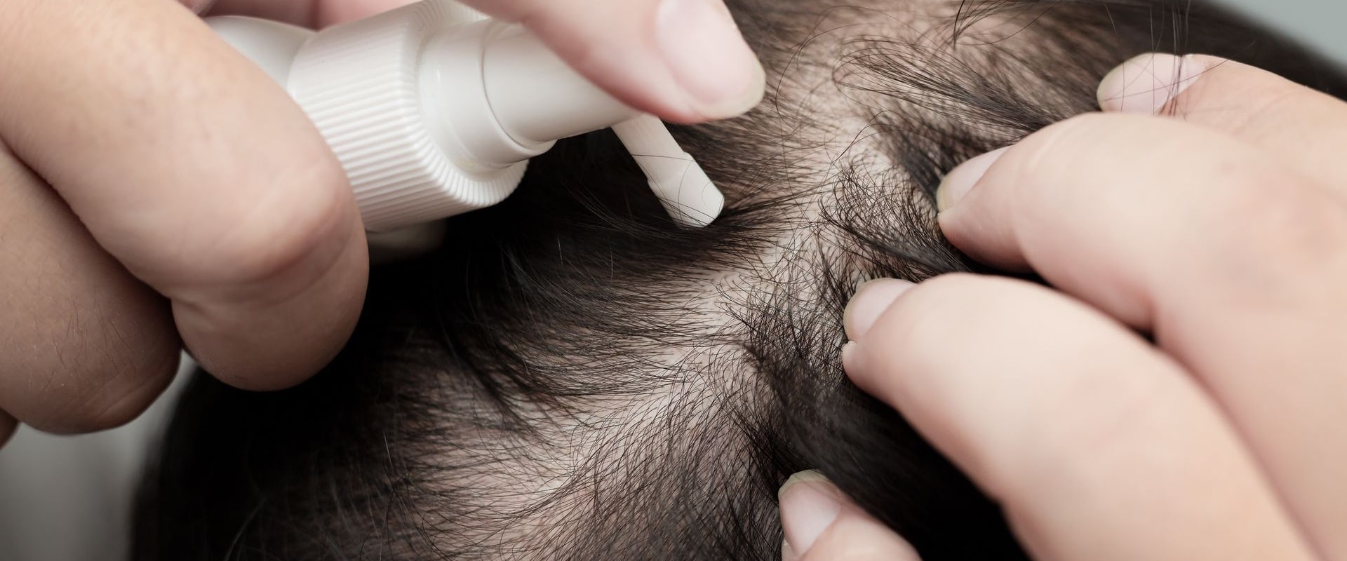 Understanding Minoxidil: A Comprehensive Look at Hair Loss Treatment