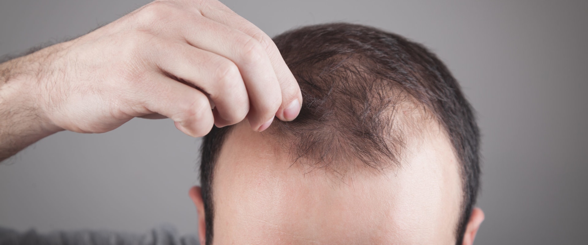 Understanding Thyroid Disorders and Hair Loss