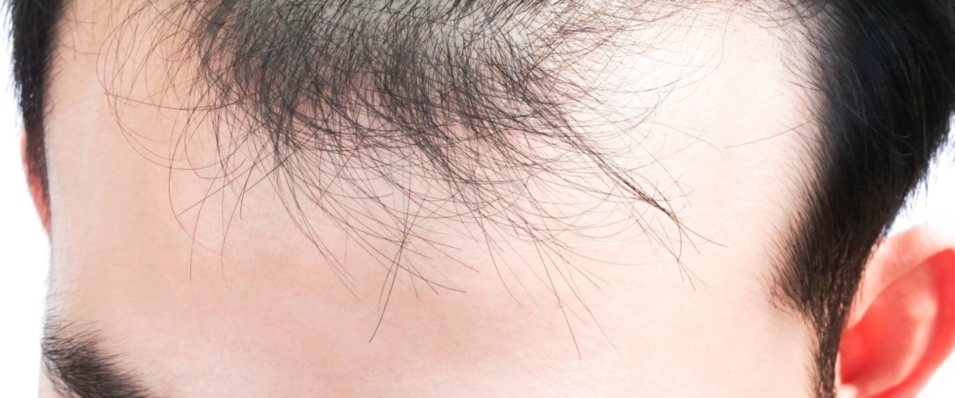 Understanding and Managing Stress-Related Hair Loss