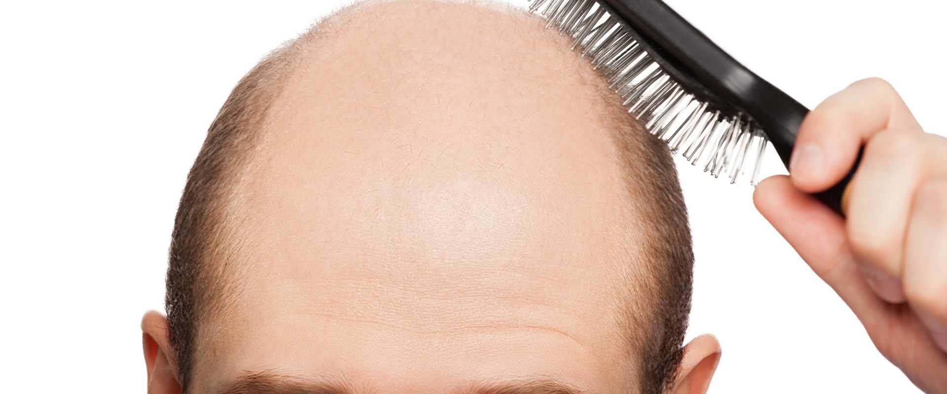 Understanding the Link Between Poor Diet and Hair Loss