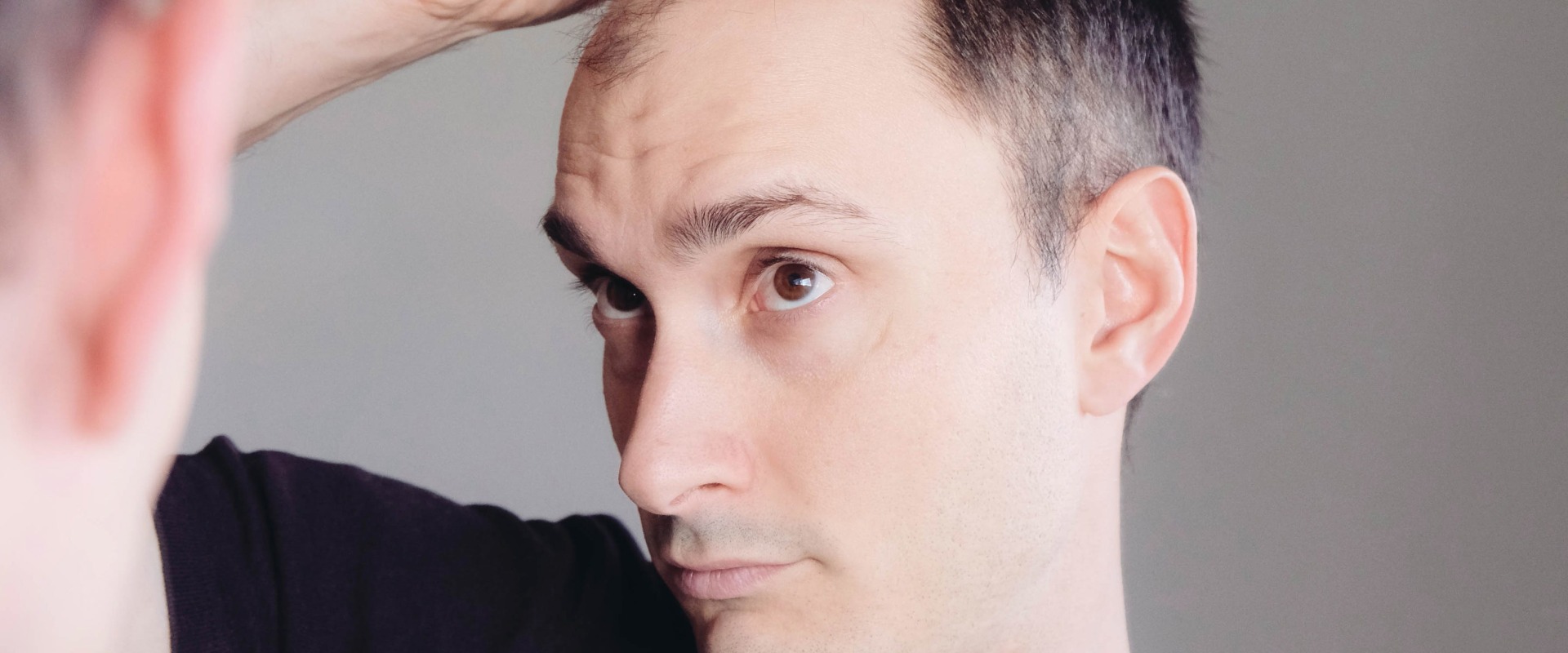 Lifestyle Changes for Preventing Male Pattern Baldness