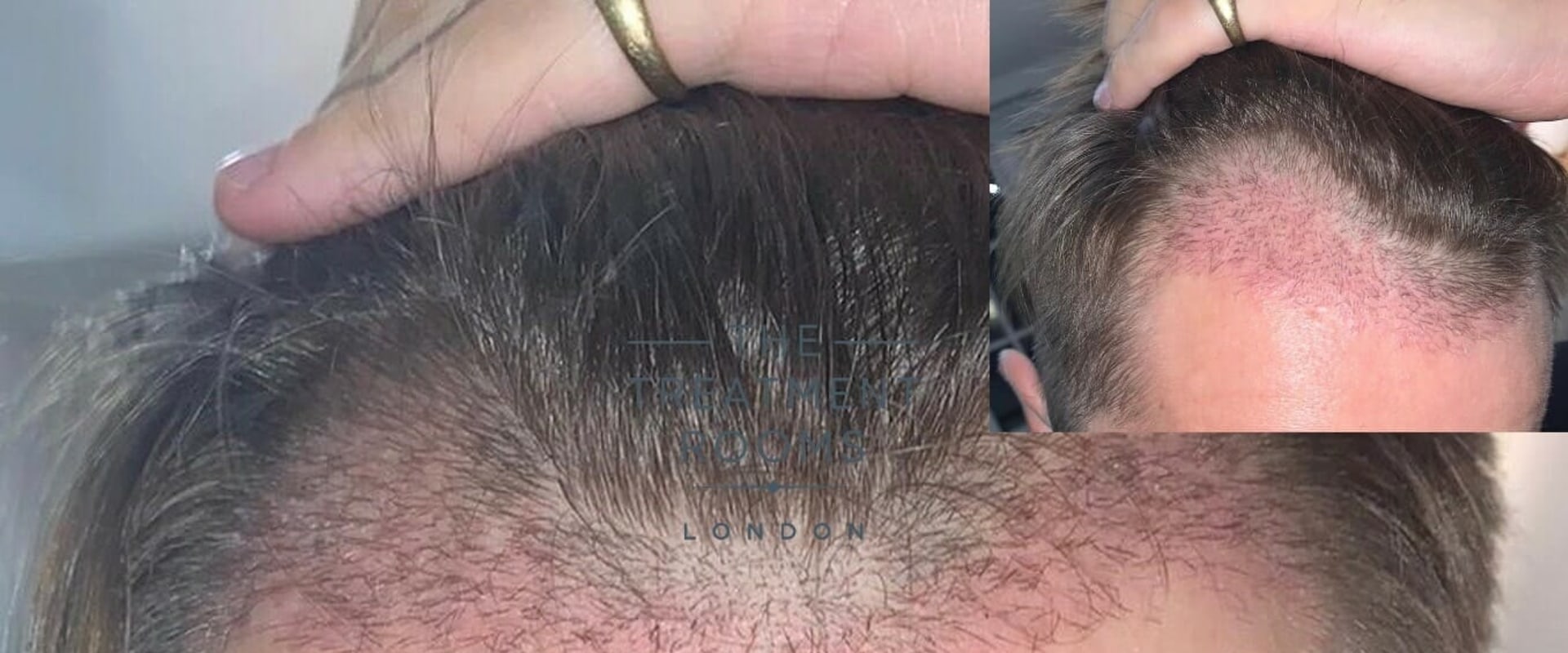 Understanding and Overcoming Hair Transplants