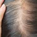 Understanding Iron-Deficiency Anemia and its Link to Hair Loss