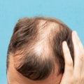 Lifestyle Factors and Male Pattern Baldness: Understanding and Managing Mental and Physical Challenges