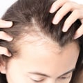 Understanding and Overcoming Female Hair Loss