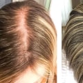 Understanding and Overcoming Pregnancy and Postpartum Hair Loss