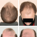 Understanding Male Pattern Baldness: Causes and Management