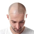 Scalp Camouflage Techniques: Improving Mental and Physical Health through Hair Loss Solutions