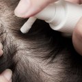 Understanding Minoxidil: A Comprehensive Look at Hair Loss Treatment