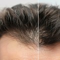 Understanding and Overcoming Hereditary Hair Loss: Tips and Techniques