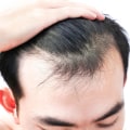 Understanding and Managing Stress-Related Hair Loss