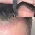 Understanding and Overcoming Hair Transplants