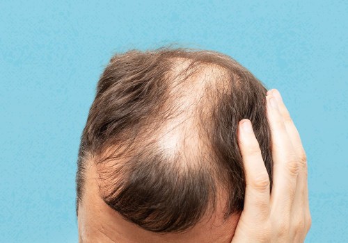 Lifestyle Factors and Male Pattern Baldness: Understanding and Managing Mental and Physical Challenges