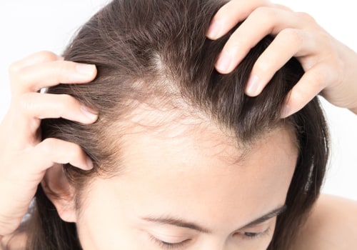 Understanding and Overcoming Female Hair Loss