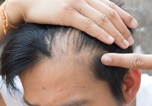 Understanding Hormonal Changes and Male Pattern Baldness