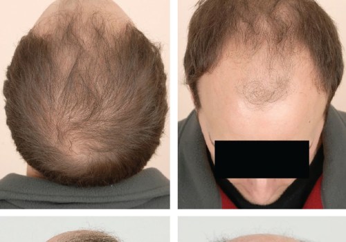 Understanding Male Pattern Baldness: Causes and Management