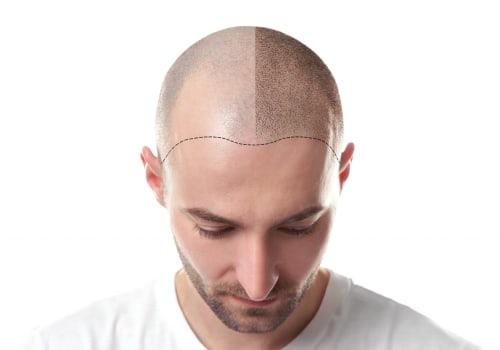 Scalp Camouflage Techniques: Improving Mental and Physical Health through Hair Loss Solutions