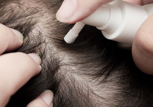 Understanding Minoxidil: A Comprehensive Look at Hair Loss Treatment